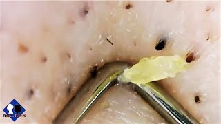 blackheads removal close up part6 [upl. by Pauline]