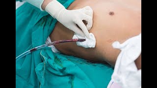 Chest drain tube intercostal tube thoracostomy procedure [upl. by Amikehs]