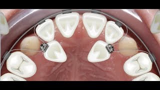 Orthodontic case report for palatally impacted canines traction [upl. by Ferren]