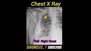 Flail chest  Diagnosis  CXR PA Practical case  Radiology [upl. by Rexferd]