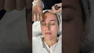 Microneedling with PRP  Dr Medispa [upl. by Garlinda]