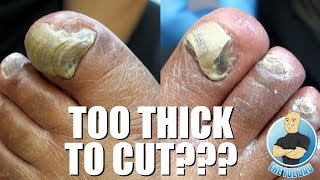 TRIMMING EXTREMELY THICK TOENAILS  FULL TREATMENT [upl. by Symons248]