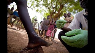 नारू या आजाराबद्दल माहिती गिनी वर्म Guinea Worm [upl. by Nylanaj521]