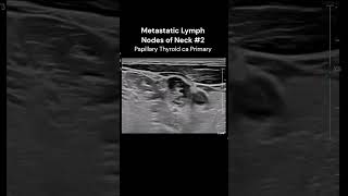 Neck Lymph Nodes2 ultrasound imaging cancerawareness cases [upl. by Nick70]