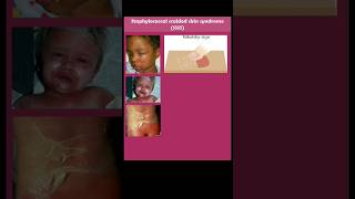 staphylococcal scalded skin syndrome SSSS [upl. by Kara-Lynn]