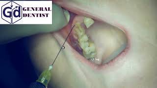 Infiltration anesthesia for extraction 12 tooth [upl. by Eille579]