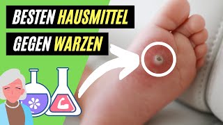 ✅ Warzen entfernen mit Hausmitteln  5 hilfreiche TIPPS gegen Warzen [upl. by Eltsyrk18]