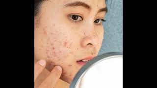 Severe Acne treatment [upl. by Araiek]