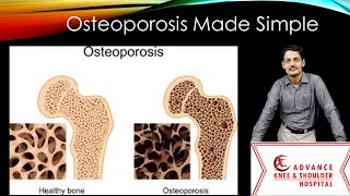 Osteoporosis Made Simple [upl. by Auhsej633]