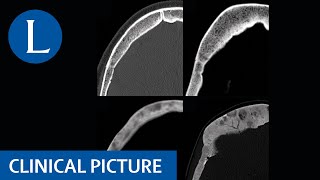 Bones moans and abdominal groans in hyperparathyroidism [upl. by Rehpotsrhc]