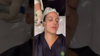 Rejuve Therapy amp Skin Needling  Results Laser Clinic treatments microneedling [upl. by Hakim683]