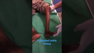 sustained ankle clonus  DR TMAM [upl. by Nnylanna]