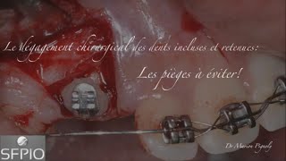 Le dégagement chirurgical des dents retenues  les pièges à éviter [upl. by Kucik]