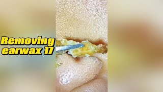 Removing earwax 17 [upl. by Ahsikram]