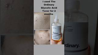 I tested The Ordinary  Glycolic Acid Toner for 2 months😳 makeup skincare ytshorts trending [upl. by Gilbert]