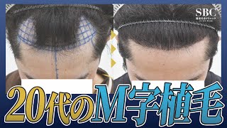 【20代の自毛植毛】半年でヘアライン激変！術後1週間の様子も公開します [upl. by Ikir229]