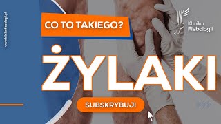 Żylaki  co to takiego [upl. by Jaffe516]