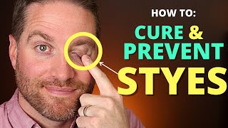 How To CURE And PREVENT STYES Get Rid Of A Hordeolum stye And Chalazion Fast [upl. by Alesandrini700]