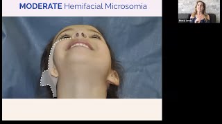 Live Chat Hemifacial Microsomia and PIER for Microtia [upl. by Efal430]