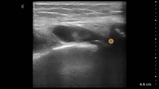 Lateral Meniscus and Knee Effusion  Ultrasound Image Interpretation [upl. by Allina695]