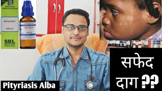 Pityriasis alba homeopathic treatment  explain चेहरे पर सफेद दाग [upl. by Darline]