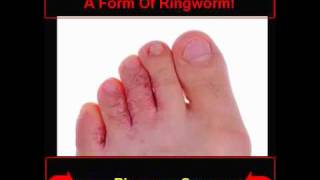 Ringworm Pics  How To Know If You Are Infected [upl. by Goldshlag792]