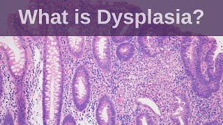 What is Dysplasia  Pathology mini tutorial [upl. by Malvina]