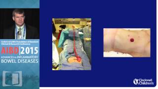 DEBATE Treatment for Severe Refractory Hospitalized Ulcerative Colitis Patients  Surgery [upl. by Calandria]