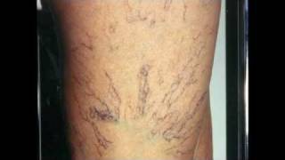 Varicose Veins Treatment [upl. by Zeke]