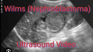 NEPHROBLASTOMA Wilms Tumor ultrasound appearence on video demonstration [upl. by Enitsenre]