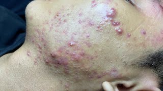 ACNE TREATMENT VU QUYNH MI Blackheads On Boy Face 2024 [upl. by Abel]