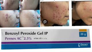 Pernex AC 25 Gel Benzoyl Peroxide Gel [upl. by Grefer806]