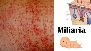 Miliaria Heat rash [upl. by Emoraj439]