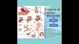 ENDOCRINOLOGÍA Síndrome de Sheehan [upl. by Tobin]