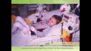 Epidermolysis Bullosa EB Awareness video extended [upl. by Homans108]