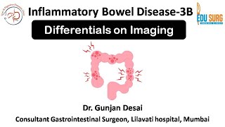 How Imaging Helps Distinguish Ulcerative Colitis vs Crohns Disease amp Differential Diagnoses [upl. by Bricker194]