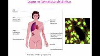 umh1947 201213 Lec001 Otras enfermedades de base autoinmune I [upl. by Airtal804]