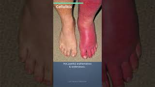 Learn in easy way about Cellulitis amp its treatment shorts [upl. by Fairweather753]