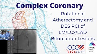 Rotational Atherectomy and DES PCI of LMLCxLAD Bifurcation Lesions  CCC Live Nov 2016 [upl. by Acinna]