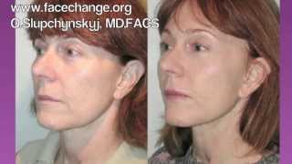 Mid Facelift Procedure Video [upl. by Ahsatam]