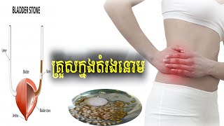 ជម្ងឺគ្រួសតម្រងនោម​  Lithiasis Renal or Calcul Renal [upl. by Granger]