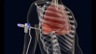 How to make a Thoracentesis pleural puncture with Pleurasafe [upl. by Aelgna]