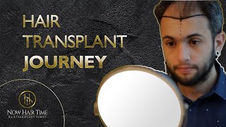 Hair Transplant Journey  6 [upl. by Richmond]