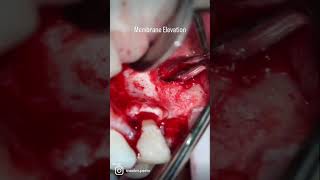 External Sinus Lift [upl. by Atenik]