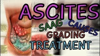 What are Ascites Transudate vs Exudate  SAAG  Fluid Wave Test  Shifting Dullness  Treatment [upl. by Korfonta]