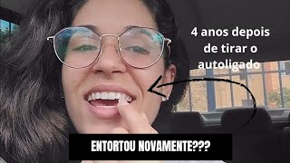 APARELHO AUTOLIGADO  4 ANOS DEPOIS O DENTE ENTORTOU [upl. by Sebastiano220]