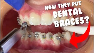 How they put braces  Dental Braces Tooth Time Family Dentistry New Braunfels [upl. by Sydney]