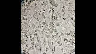 فحص الادرار العام urinalysis urineexamination GUE epithelial cells pus cells Bacteria [upl. by Fusuy]