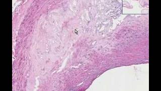 Histopathology Coronary arteriesAtherosclerosis [upl. by Labotsirhc]