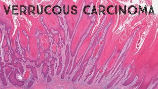 Verrucous carcinoma its NOT caused by HPV pathology dermpath dermatology dermatopathology [upl. by Larkin967]